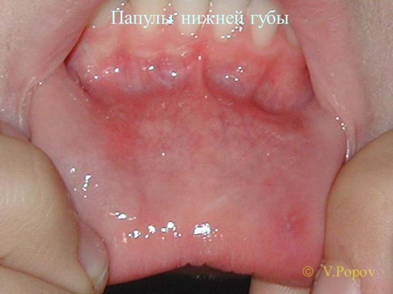 Папулы нижней губы